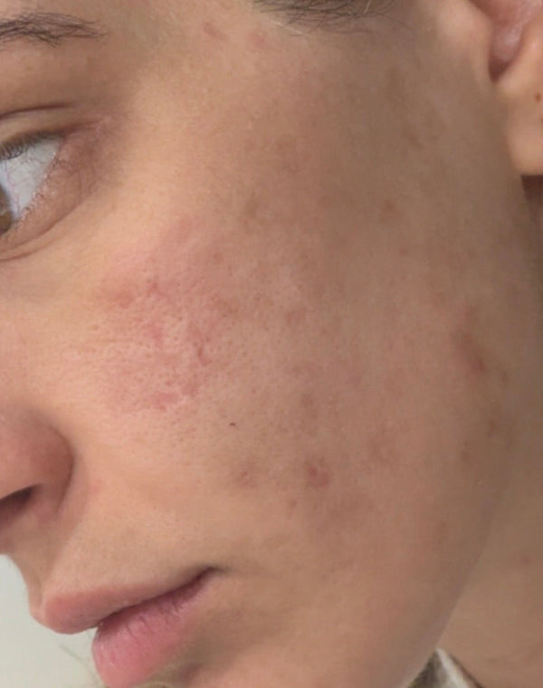 skin picking