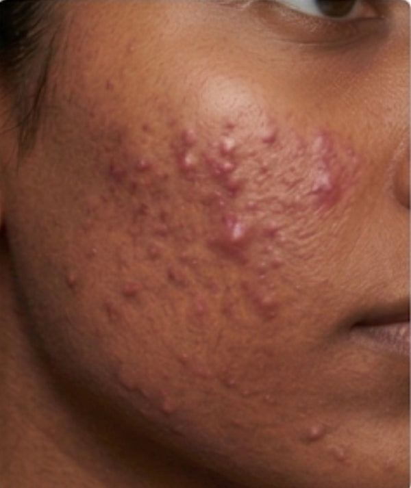 blemishes