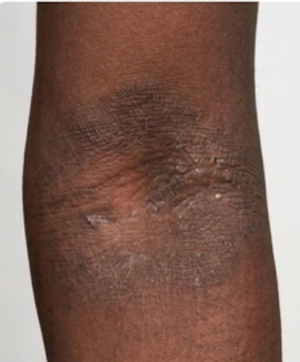 eczema